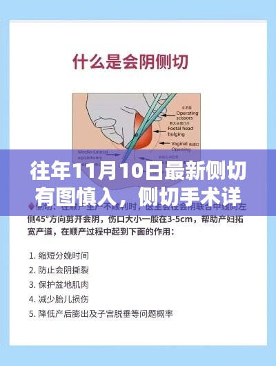 侧切手术详解，最新技术科普文章，慎入有图，往年1月最新更新