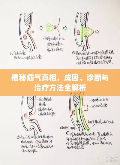 揭秘疝气真相，成因、诊断与治疗方法全解析